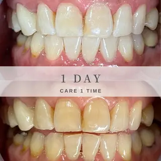 HaHaHa ホワイトニングのその他イメージ