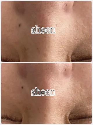 Chalon所属・REVI取扱・肌悩み 毛穴Chalonのエステ・リラクイメージ