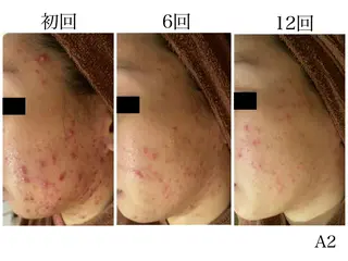 ミディアム メンズ マツエク・マツパ アイブロウ ニキビ・肌質改善専門 ♡人生が変わるサロンのエステ・リラクイメージ