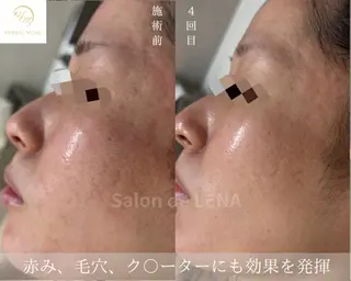 ハーブピーリング・毛穴ケア専門サロンSalon de LENA 栄店所属・ハーブピーリング専門 サロンドレナ　白藤のエステ・リラクイメージ