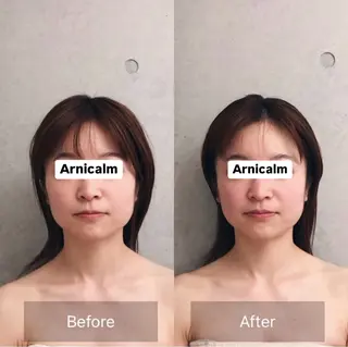 ハーブピーリング 肌再生ピーリング/のエステ・リラクイメージ