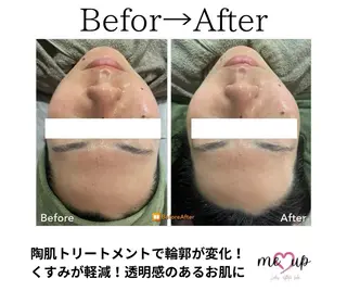 Meupニキビ専門店 背中/ハーブ/肌管理のその他イメージ