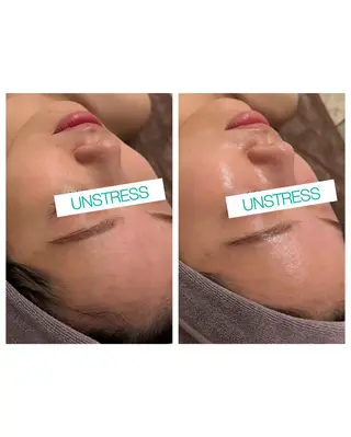 ☆痩身/小顔☆ ハイパーナイフexのエステ・リラクイメージ