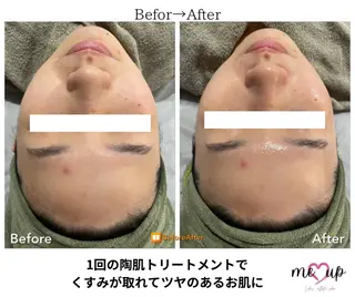 Meupニキビ専門店 背中/ハーブ/肌管理のその他イメージ