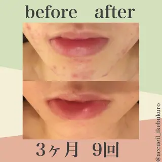 ミディアム カラー ヘアアレンジ メンズ キッズ ネイル マツエク・マツパ ニキビ・肌質改善専門 ♡人生が変わるサロンのエステ・リラクイメージ