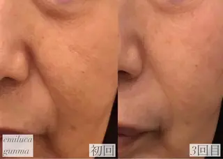 emiluca西目/ 毛穴洗浄/細胞美容のエステ・リラクイメージ