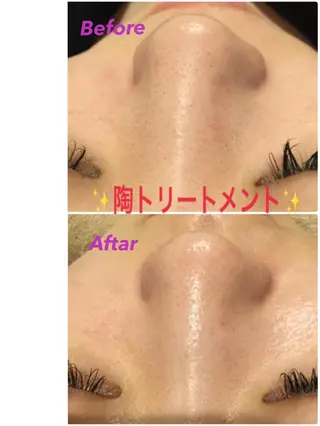 【リベルハーブピーリング認定店】敏感肌・美白脱毛専門店Dione立川店所属・Dione 立川店のエステ・リラクイメージ