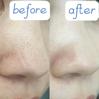 べアール所属・小顔/毛穴/ニキビ salon bealのエステ・リラクイメージ