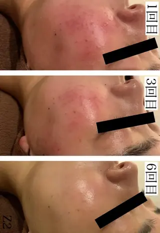 ショート カラー パーマ ヘアアレンジ メンズ キッズ ネイル マツエク・マツパ アイブロウ 夏までに肌荒れ卒業 するサロン🌻のエステ・リラクイメージ