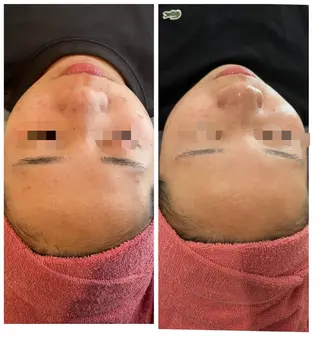 【リベルハーブピーリング認定店】敏感肌・美白脱毛専門店Dione立川店所属・Dione 立川店のエステ・リラクイメージ