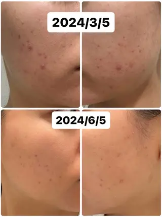 BA/肌質改善/ ゆりのエステ・リラクイメージ