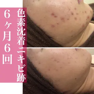 夏までに肌荒れ卒業 するサロン🌻のエステ・リラクイメージ