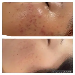 セミロング カラー パーマ ヘアアレンジ メンズ キッズ ネイル マツエク・マツパ アイブロウ ニキビ特化型エステ 🍓最短で肌質改善のエステ・リラクイメージ