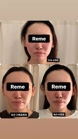 美容鍼灸サロンRemeリミー所属・美容鍼WINBACK サロンRemeのエステ・リラクイメージ