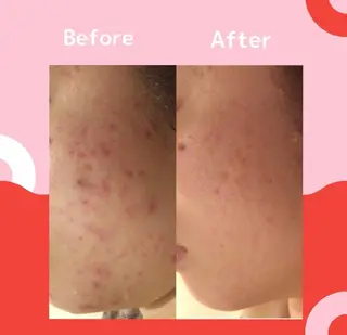 🔥3か月で肌革命 🔥ニキビ専門店のエステ・リラクイメージ