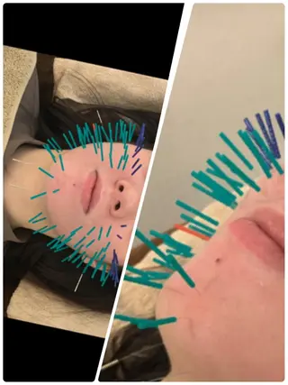 表参道鍼灸院K 美容鍼🔮ララピールのエステ・リラクイメージ