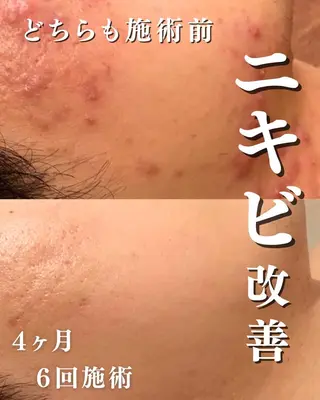 6万人の美肌実績🔥 最短ニキビ改善のエステ・リラクイメージ