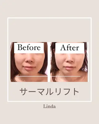 アイラッシュ&エステサロンLinda西宮所属・小顔&毛穴・肌質改善 LINDA西宮 AIのエステ・リラクイメージ