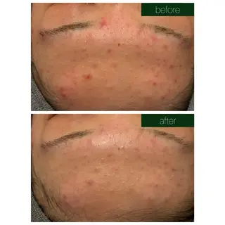 ☆痩身/小顔☆ ハイパーナイフexのエステ・リラクイメージ