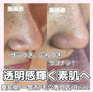 Reine BeautySalon所属・毛穴/シミ肝斑/脱毛 横山梨里のエステ・リラクイメージ