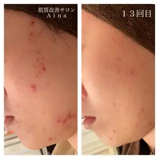 ミディアム カラー パーマ ヘアアレンジ メンズ キッズ ネイル マツエク・マツパ ニキビ跡専門サロン Ainaのエステ・リラクイメージ