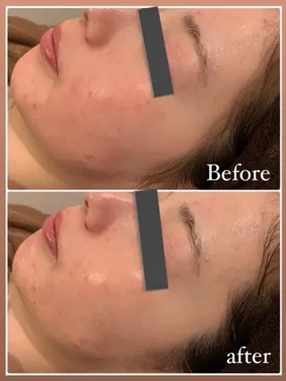 肌質改善ハーブピー リング🌿RINAのエステ・リラクイメージ