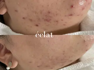 private salon éclat所属・ニキビ・毛穴専門 éclat/エクラのエステ・リラクイメージ