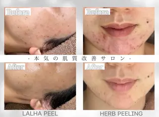 毛穴・ニキビケア　ハーブピーリング【肌管理専門店】WHITE AQUA鳳店所属・ホワイトアクア 鳳店のエステ・リラクイメージ
