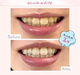 エクシアホワイト調布所属・umi❤︎ ホワイトニングのその他イメージ