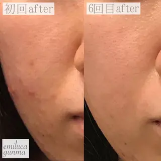 emiluca西目/ 毛穴洗浄/細胞美容のエステ・リラクイメージ