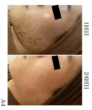 学生ニキビ改善🍀 優しい肌質改善のエステ・リラクイメージ