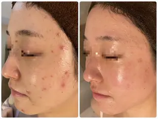 ニキビ･毛穴悩み特化 /CHISATOのエステ・リラクイメージ