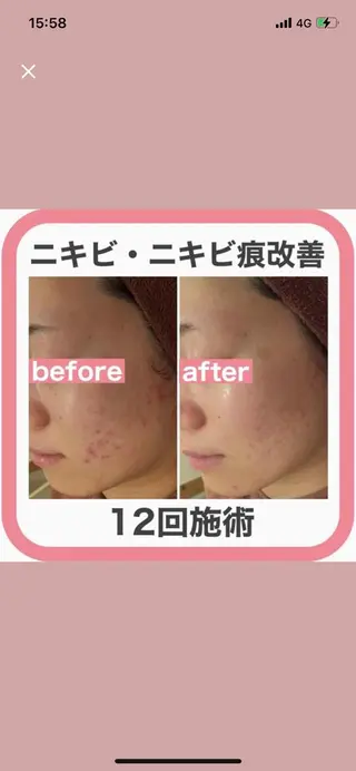 ロング カラー パーマ ヘアアレンジ メンズ キッズ ネイル マツエク・マツパ アイブロウ ニキビ特化型エステ 🍓最短で肌質改善のエステ・リラクイメージ