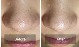 エイジングケアサロンBIOEL所属・肌質改善BIOELプ ラズマ/ラミピールのエステ・リラクイメージ