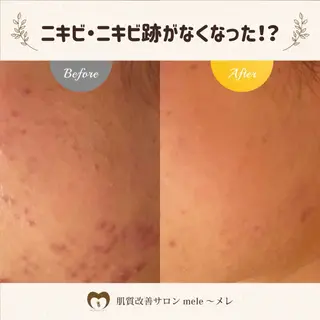 ニキビケア/毛穴/ 赤み/自信の肌✨森園のエステ・リラクイメージ