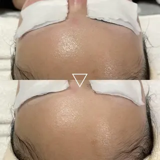 肌質改善＋小顔 🤍Kyrieのエステ・リラクイメージ