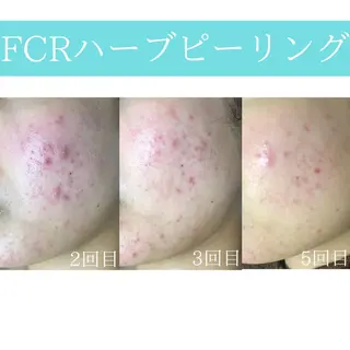 心斎橋痩身ダイエット 韓国.美容鍼.小顔のエステ・リラクイメージ