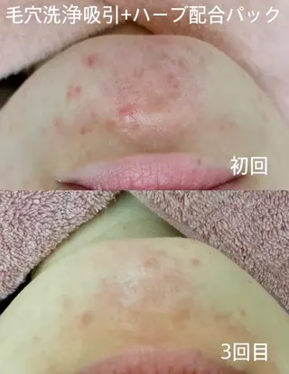 肌ケア＆毛穴洗浄 Cheriのエステ・リラクイメージ