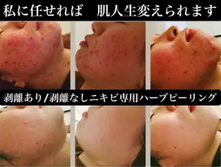 ニキビ/肌質改善専門 Snow skinのエステ・リラクイメージ
