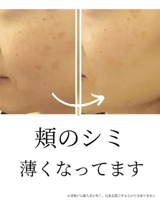 水光肌ピーリング ハーブピーリングのエステ・リラクイメージ