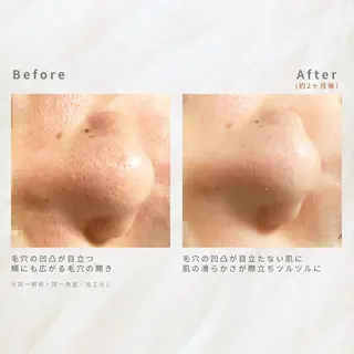 繰り返すニキビ・毛穴 ✨つくば肌質改善専門のエステ・リラクイメージ