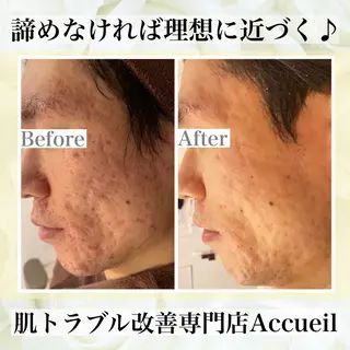 ニキビ・肌質改善専門 ♡人生が変わるサロンのエステ・リラクイメージ