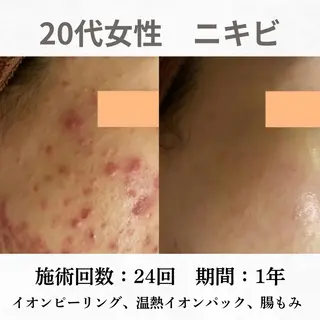 重度ニキビ専門🌷 ダウンタイムなしのエステ・リラクイメージ