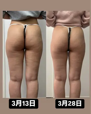 Miiju.所属・Miiju. 石巻市 脂肪冷却  鈴木のエステ・リラクイメージ