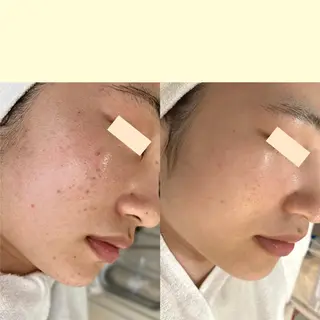 タルミ,ニキビケア専門PICHi BEAUTeピチボーテ所属・トクシゲ マホのエステ・リラクイメージ