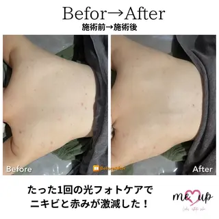Meupニキビ専門店 背中/ハーブ/肌管理のその他イメージ