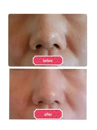 ハーブピーリング/韓国肌管理/フェイシャル/毛穴洗浄/眉毛/顔脱毛【糸脱毛専門】rev所属・ハーブピーリング🌹 毛穴洗浄❤️眉waxのエステ・リラクイメージ