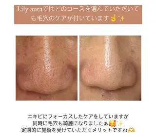 ニキビ/敏感肌/乾燥 Lilyauraのエステ・リラクイメージ