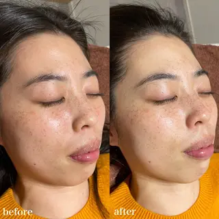 mieux所属・ハーブピーリング ¥6600のエステ・リラクイメージ