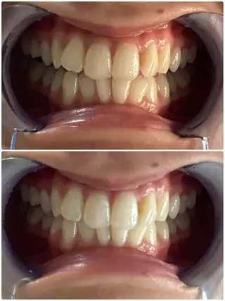 ANGEPEAU（アンジュポー）所属・セルフホワイトニング アンジュポーのその他イメージ